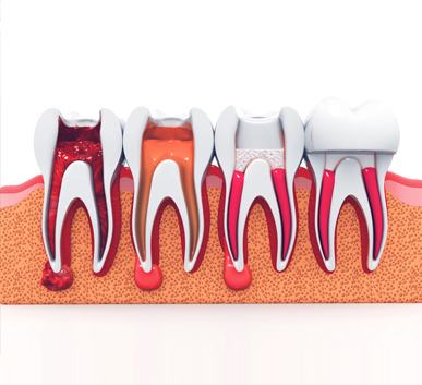 Endodontia - Tratamento de Canal